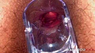 huge ass gaping with speculum in anal vision